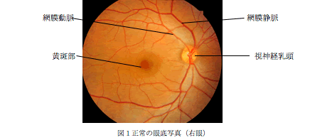 糖尿病網膜症の眼底検査とは何ですか?